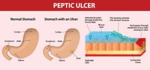 peptic ulcer inchildren