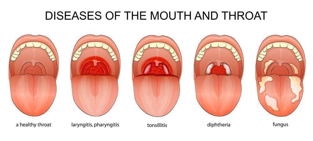 canadian-health-care-gives-information-about-pharyngitis-canadian