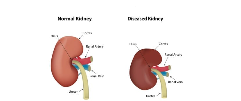 kidney disease viagra