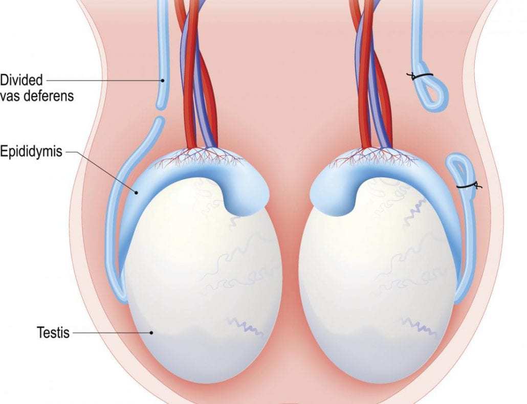 reversal vasectomy