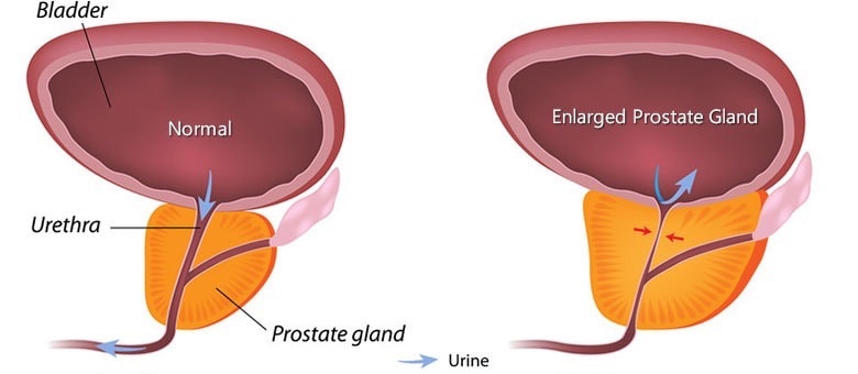 benign prostate enlargement treatment