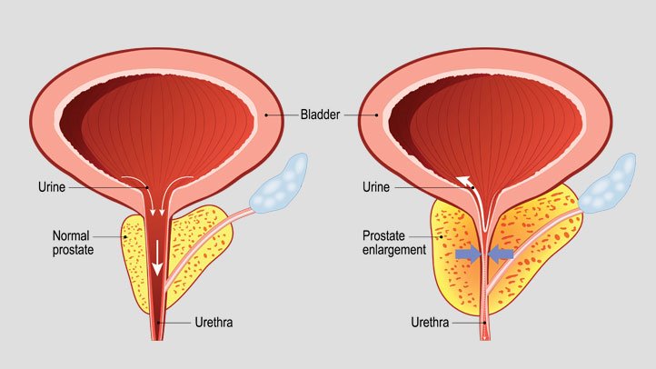 prostate enlargement and cialis