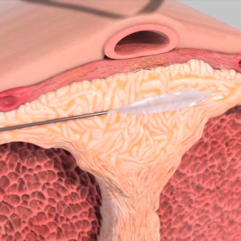 priapism fibrosis